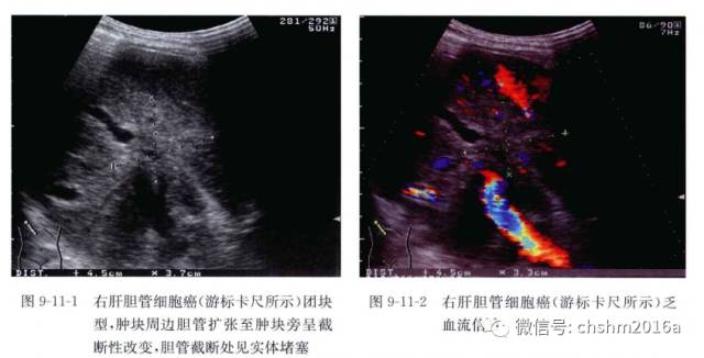 Ultrasound Imaging of Intrahepatic Cholangiocarcinoma
