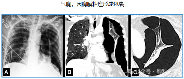 Compilation of Chest Imaging Terminology (IV)