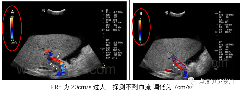 Understanding and Adjusting Parameters of Color Doppler Ultrasound Machines