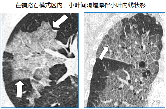 Compilation of Chest Imaging Terminology (IV)