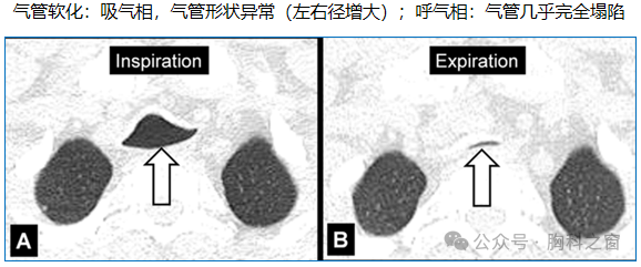 Compilation of Chest Imaging Terminology (IV)