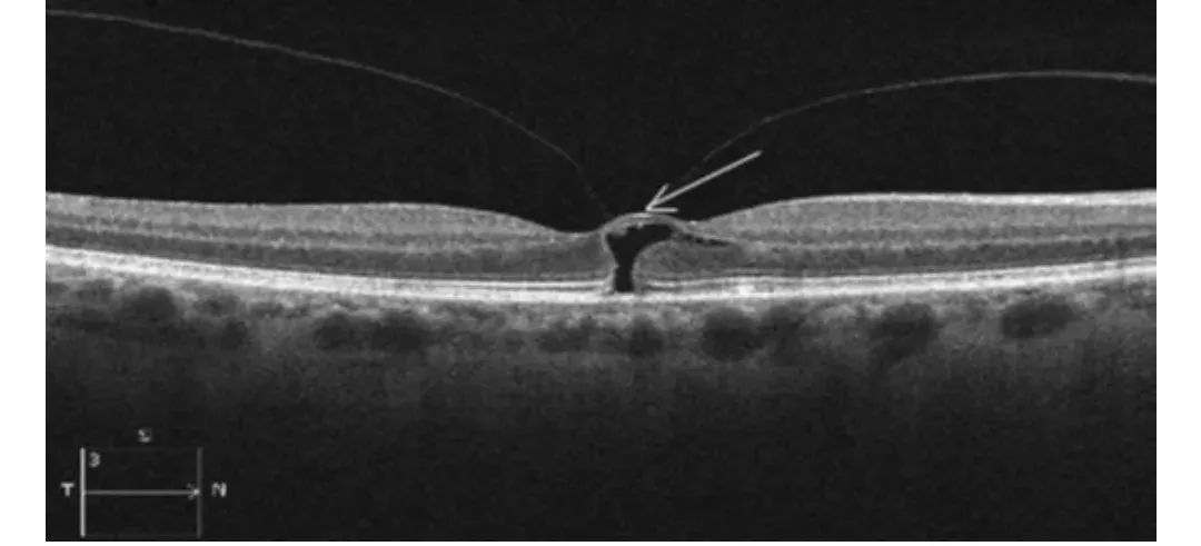 How to Identify Macular Edema in OCT Examination