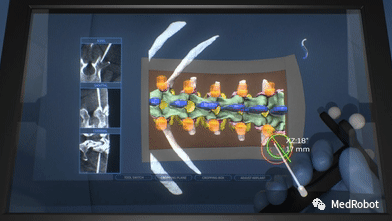 Overview of 5 Orthopedic Navigation and Surgical Robots