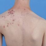 Professor Zhang Jianzhong's Guide To Acne Along Blaschko Lines In Proteus Syndrome