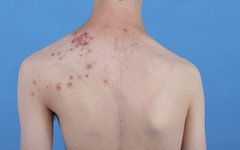 Professor Zhang Jianzhong's Guide To Acne Along Blaschko Lines In Proteus Syndrome