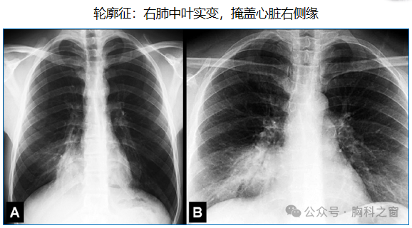 Compilation of Chest Imaging Terminology (IV)