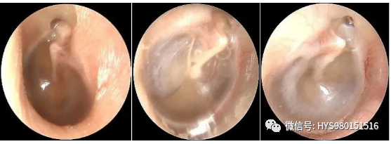 The Past And Present Of Secretory Otitis Media In Children
