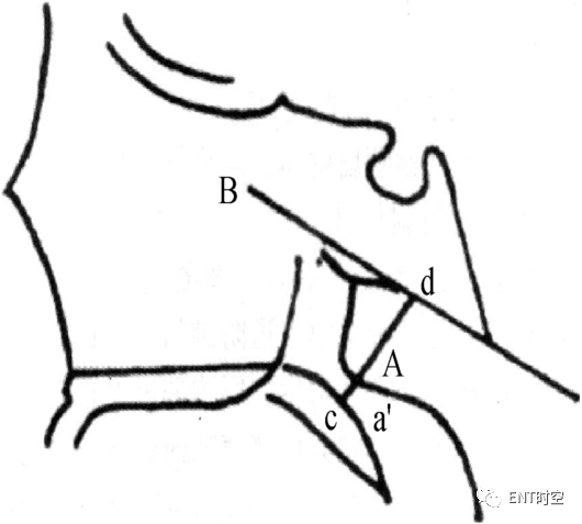 Diagnosis and Treatment of Adenoid Hypertrophy and Complications