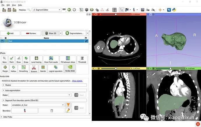 AI-Assisted Segmentation in Medical Imaging: Practical Steps and Case Studies