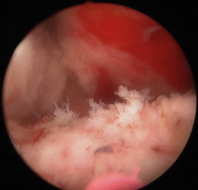 HoLEP Procedure Steps and Techniques