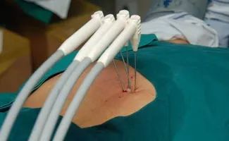 Comprehensive Review of Current Advances in Intrahepatic Cholangiocarcinoma Treatment