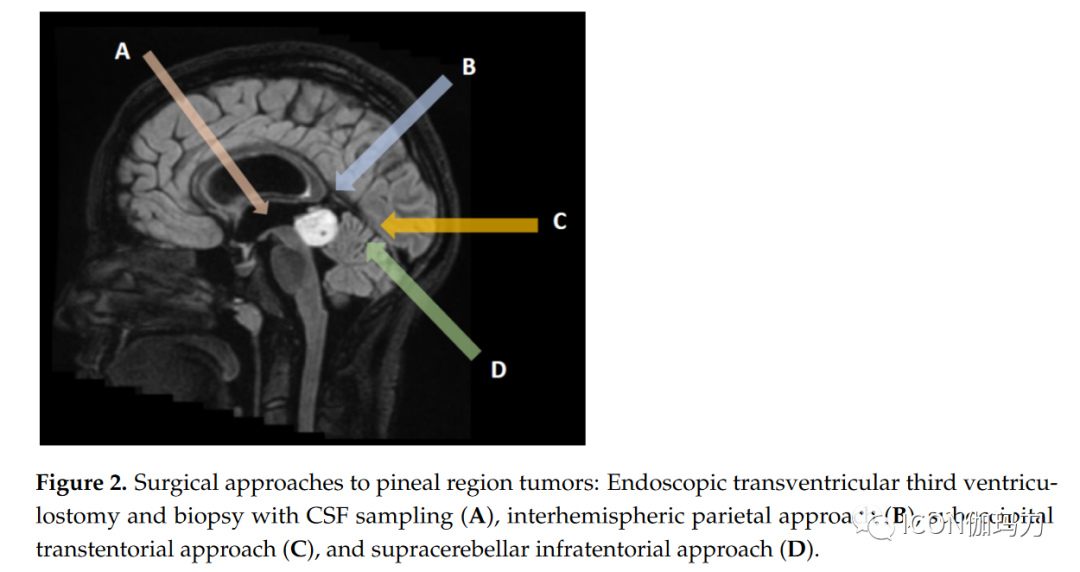 Diagnosis and Treatment of Pineal Region Tumors in Adults: A EURACAN Overview