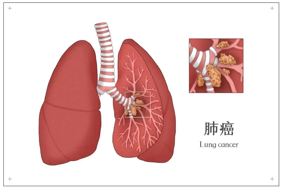 JTO Authority Review: Efficacy and Safety of Neoadjuvant Targeted Therapy for Resectable NSCLC