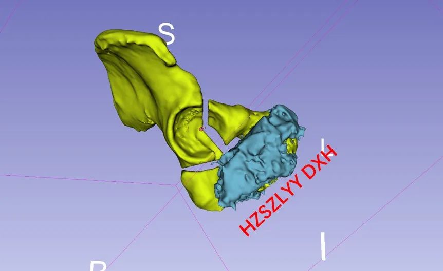 AI and Medical Imaging Fusion Modeling with 3D Printing for Precise Bone Tumor Resection