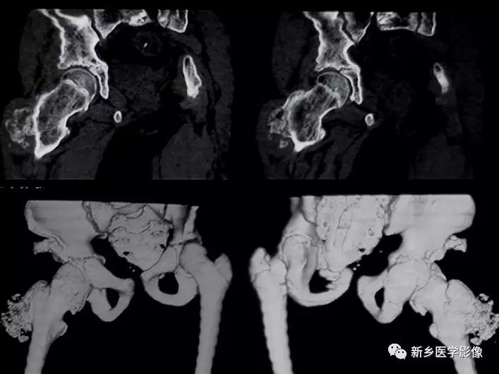 Overview of Proteus Syndrome