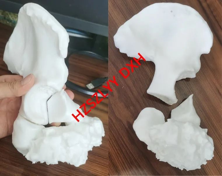 AI and Medical Imaging Fusion Modeling with 3D Printing for Precise Bone Tumor Resection