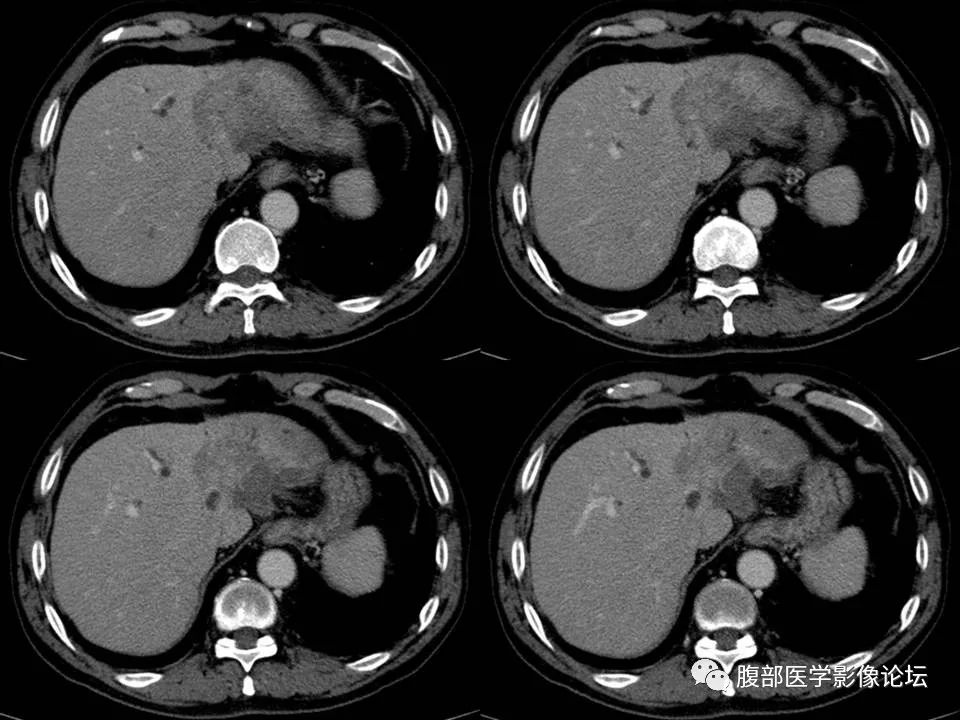 Cholangiocarcinoma: Insights and Clinical Perspectives