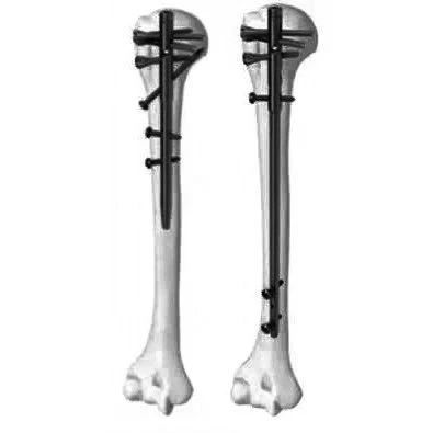 Introduction and Resetting Tips for Proximal Humerus Multilock Intramedullary Nail