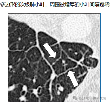 Compilation of Chest Imaging Terminology (IV)