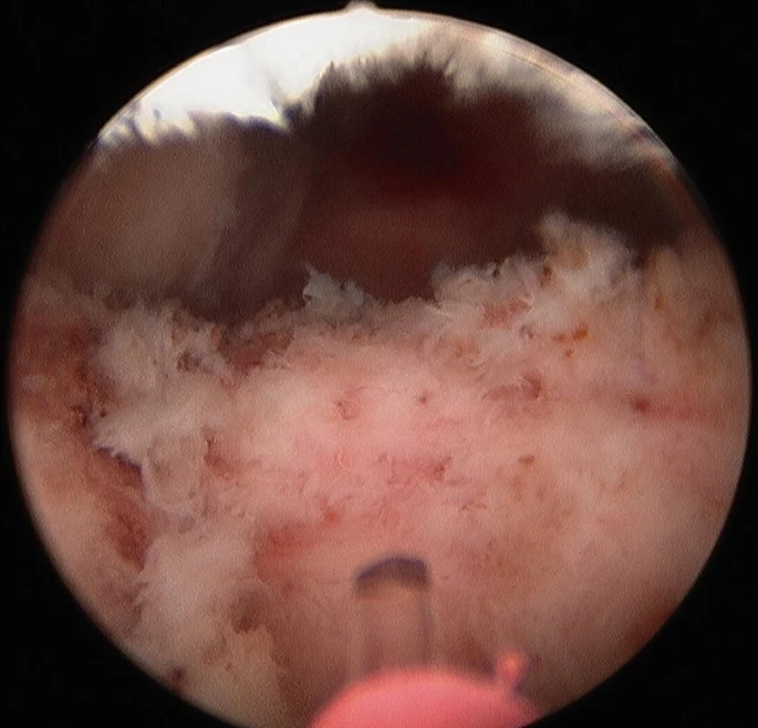 HoLEP Procedure Steps and Techniques