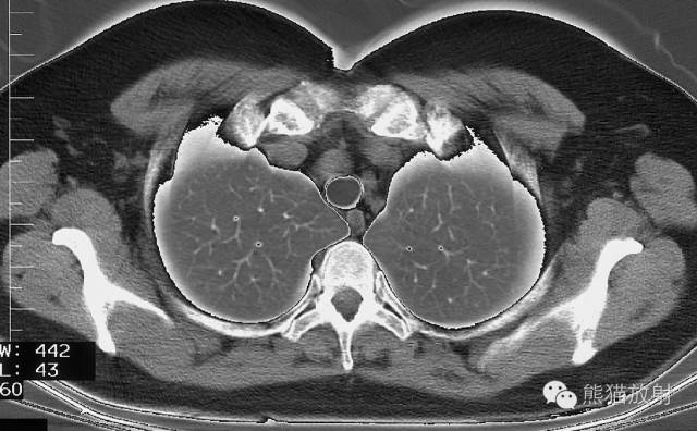 Chest Anatomy | Chest CT Cross-Sectional Anatomy