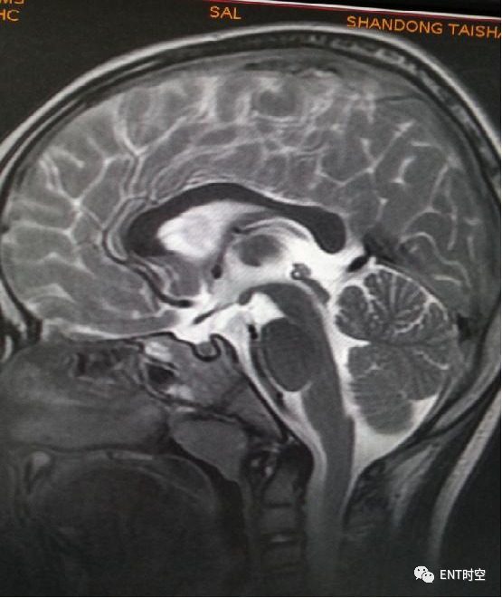 Diagnosis and Treatment of Adenoid Hypertrophy and Complications