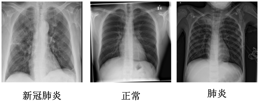 Dual Residual Res-Transformer for Accurate Pneumonia Diagnosis