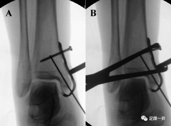 Application of 3D Printing Technology in Complex Tibial Fractures