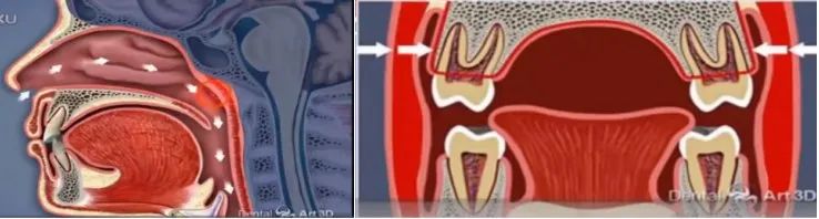 The Past And Present Of Secretory Otitis Media In Children