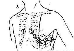 Analysis and Countermeasures for Common ECG Diagnosis Errors