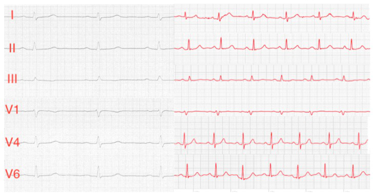 Mastering Smartwatches: Transforming Into An ECG Machine
