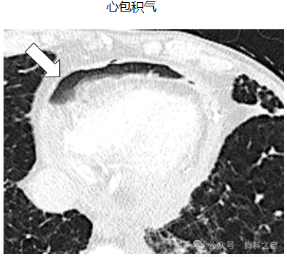 Compilation of Chest Imaging Terminology (IV)
