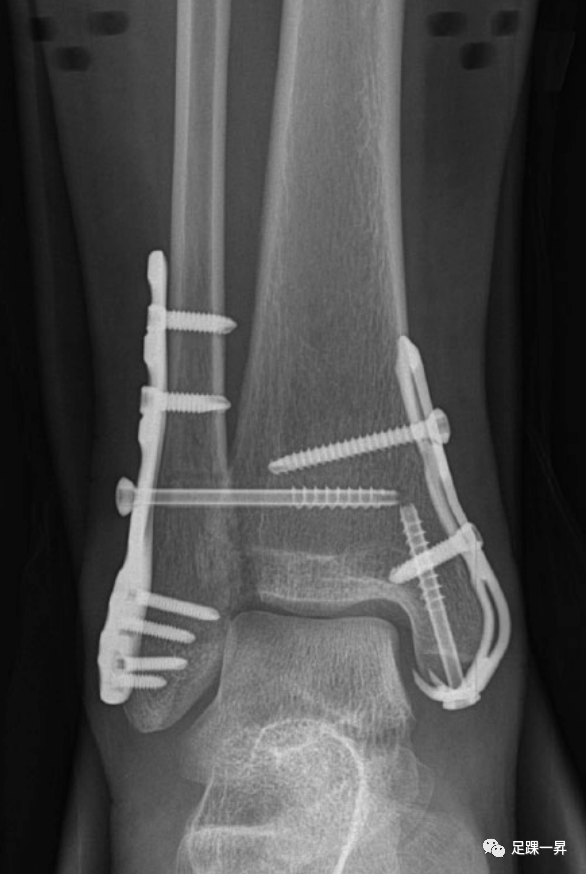 Application of 3D Printing Technology in Complex Tibial Fractures