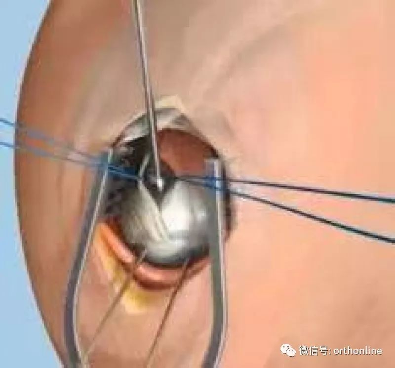 Introduction and Resetting Tips for Proximal Humerus Multilock Intramedullary Nail