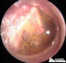 Diagnosis and Treatment of Adenoid Hypertrophy and Complications