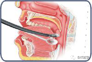 Diagnosis and Treatment of Adenoid Hypertrophy and Complications