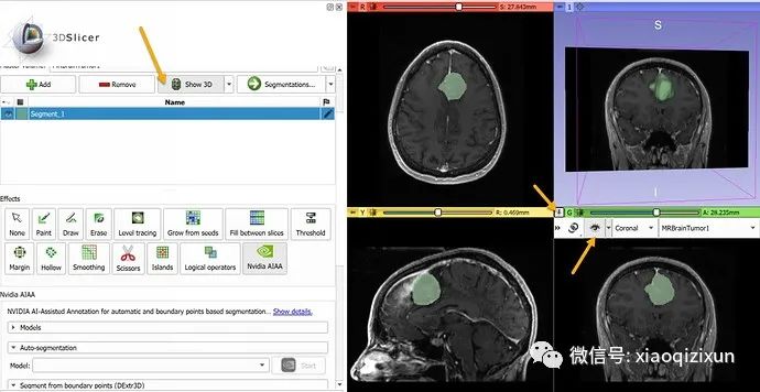 AI-Assisted Segmentation in Medical Imaging: Practical Steps and Case Studies
