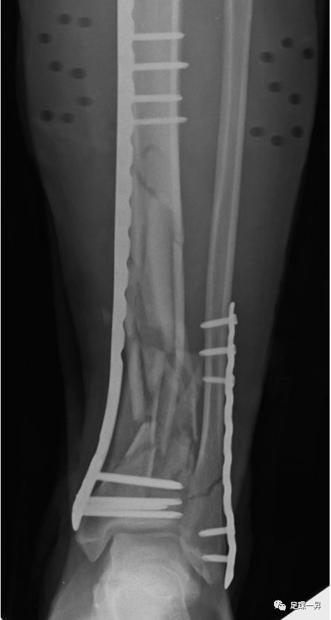 Application of 3D Printing Technology in Complex Tibial Fractures