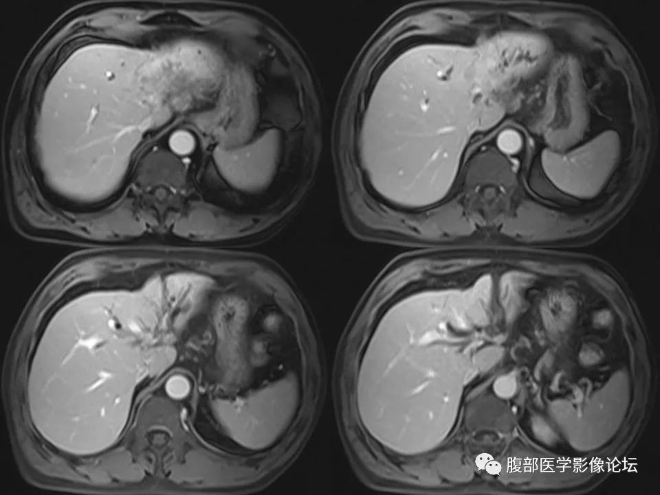 Cholangiocarcinoma: Insights and Clinical Perspectives