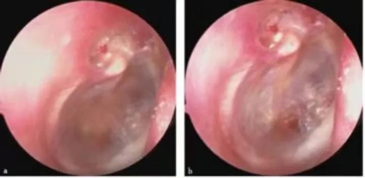The Past And Present Of Secretory Otitis Media In Children
