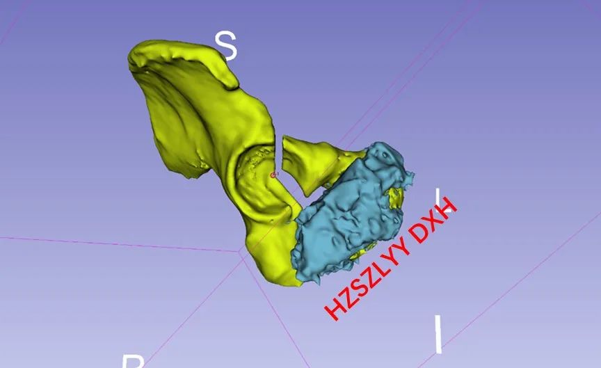 AI and Medical Imaging Fusion Modeling with 3D Printing for Precise Bone Tumor Resection