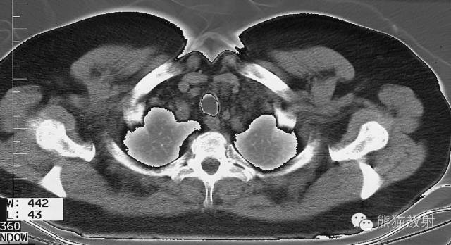 Chest Anatomy | Chest CT Cross-Sectional Anatomy