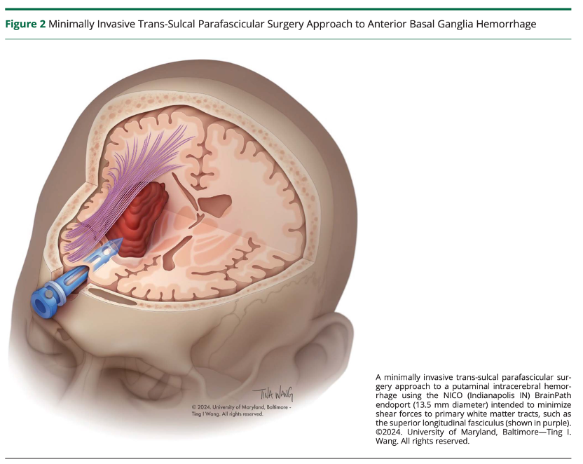 Surgical Management for Primary Intracerebral Hemorrhage