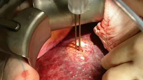 Comprehensive Review of Current Advances in Intrahepatic Cholangiocarcinoma Treatment