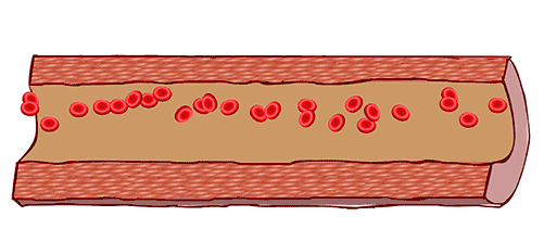 Vitamin C: The Key to Preventing Arterial Blockage