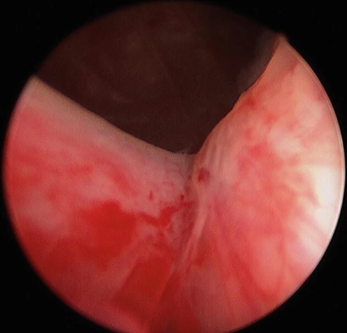 HoLEP Procedure Steps and Techniques