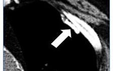 Compilation of Chest Imaging Terminology (IV)