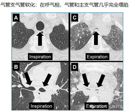 Compilation of Chest Imaging Terminology (IV)