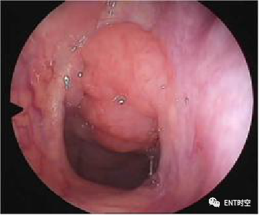 Diagnosis and Treatment of Adenoid Hypertrophy and Complications