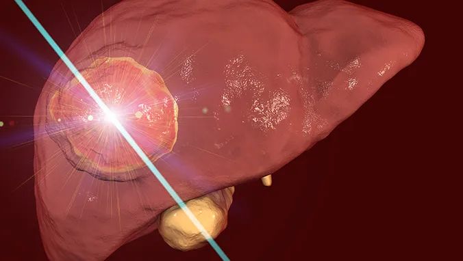 Diagnosis and Staging of Primary Liver Cancer